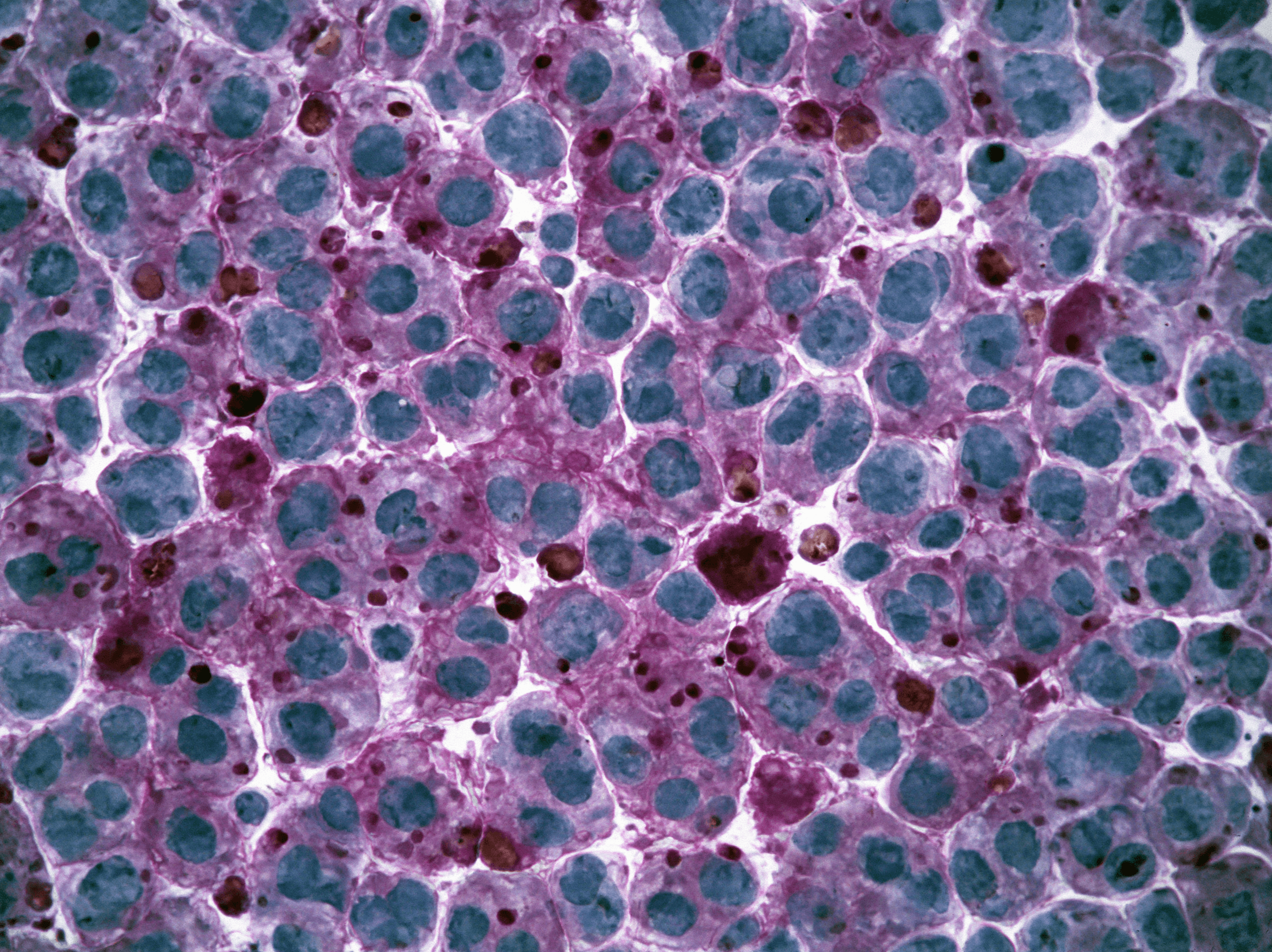 Atypical Hyperplasia After Breast Biopsy: What Happens Next? 9 0 0 1 5