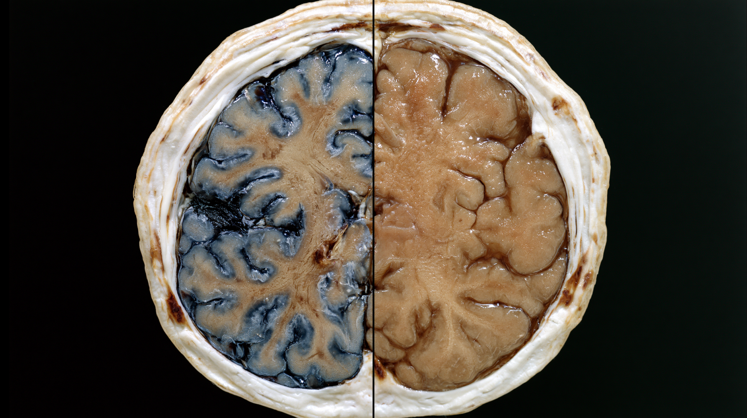 Glioma Vs Glioblastoma: Differences In Grade, Growth, Treatment, And Survival 3 0 0 11 1 scaled