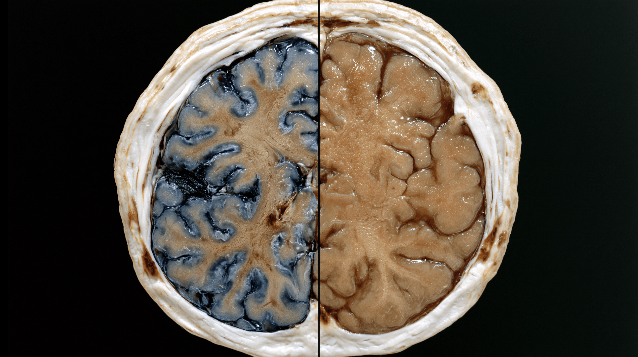 Glioma Vs Glioblastoma: Differences In Grade, Growth, Treatment, And Survival 3 0 0 11 1 scaled