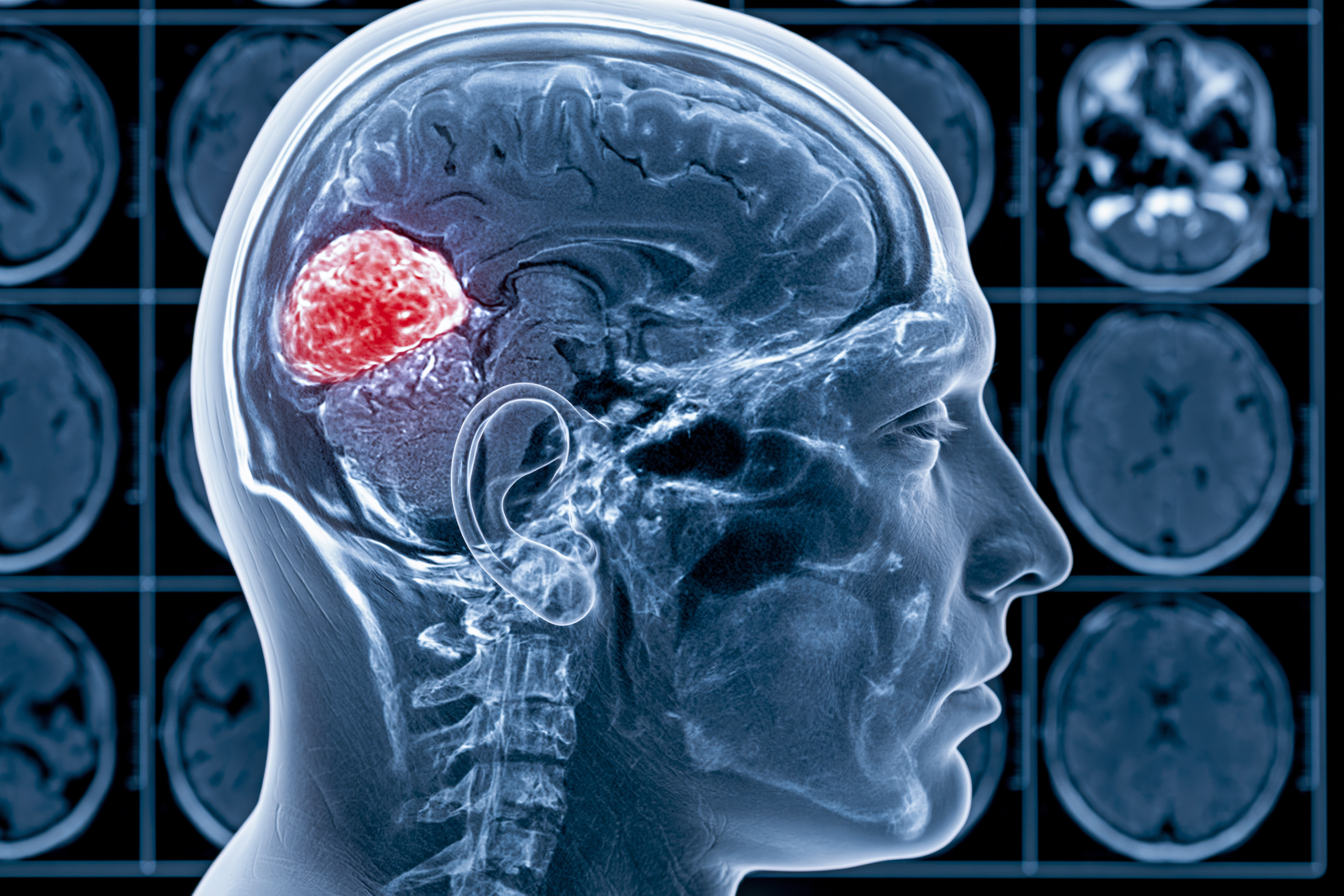 Glioma Vs Glioblastoma: Differences In Grade, Growth, Treatment, And Survival 2 0 0 12 1 scaled