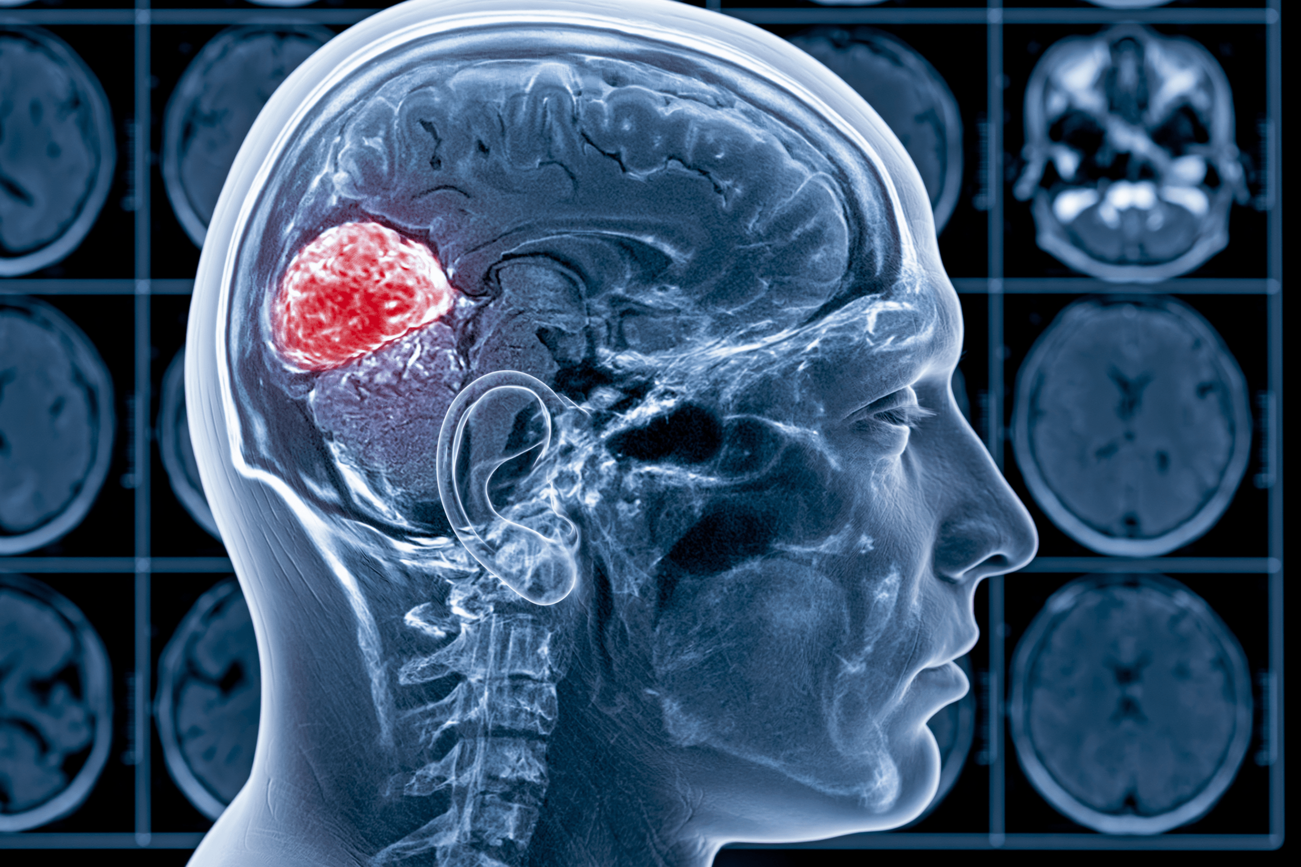 Glioma Vs Glioblastoma: Differences In Grade, Growth, Treatment, And Survival 2 0 0 12 1 scaled