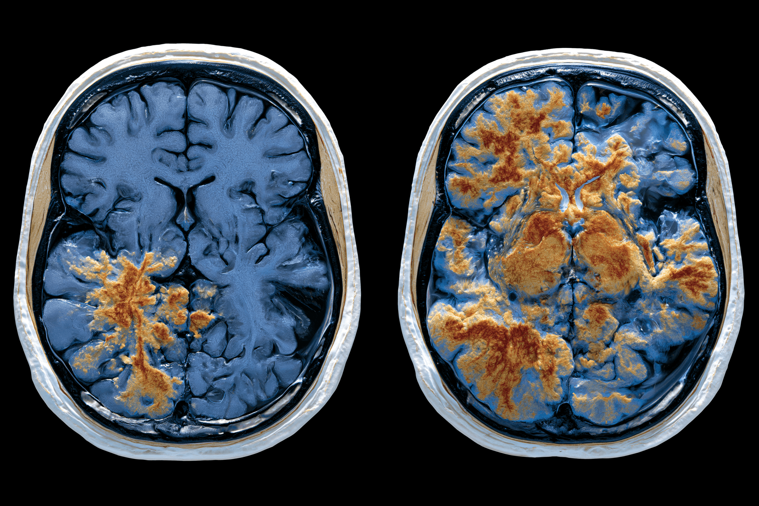 Glioma Vs Glioblastoma: Differences In Grade, Growth, Treatment, And Survival 11 0 0 14 1 scaled
