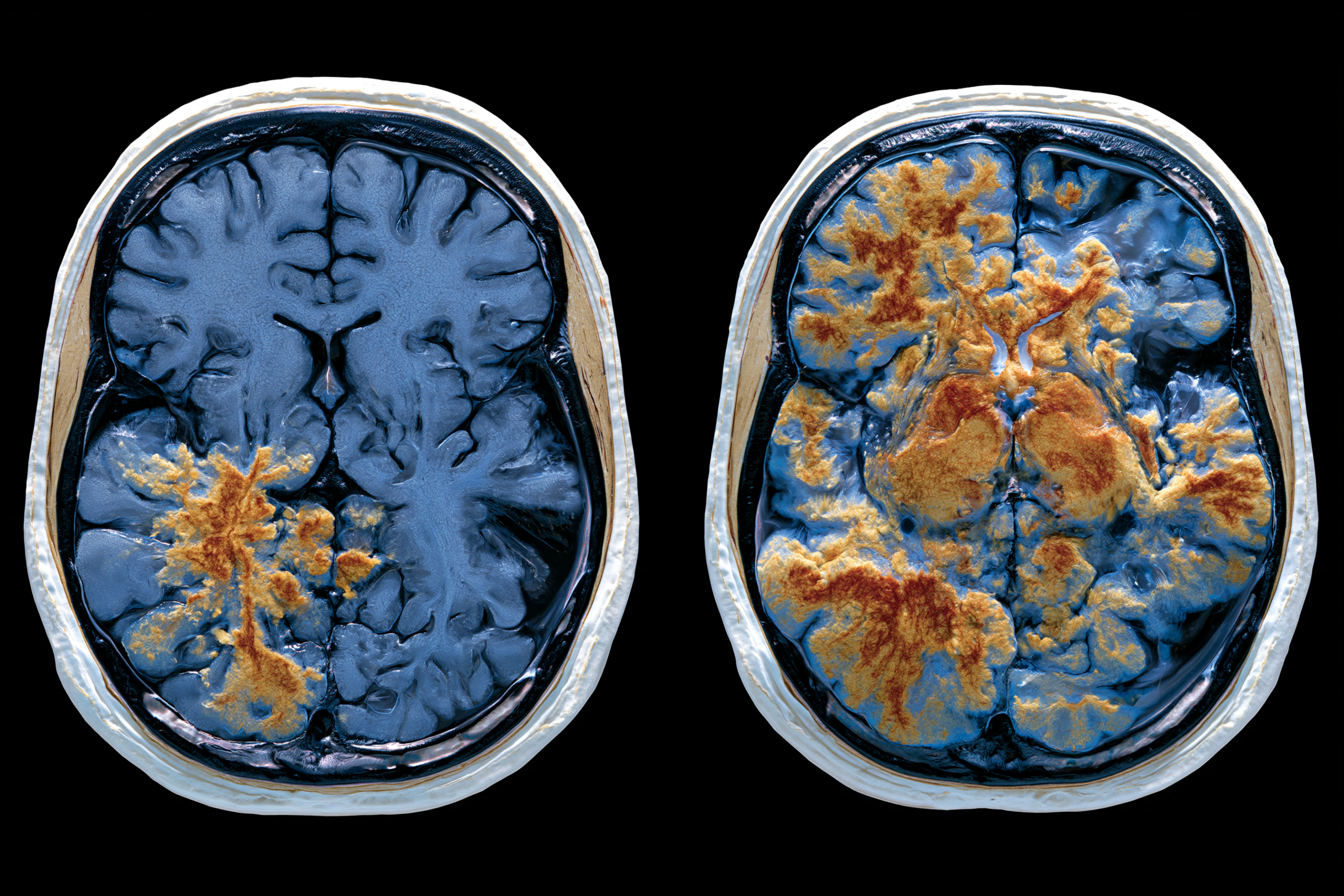 Glioma Vs Glioblastoma: Differences In Grade, Growth, Treatment, And Survival 12 0 0 15 1 scaled