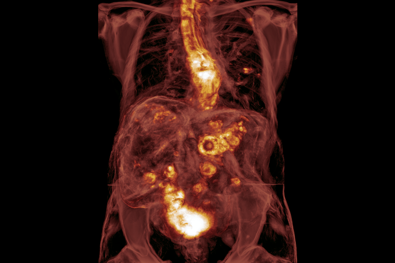 Metastatic Esophageal Cancer: Treatment, Survival And The Ayurveda Curative Model 1 0 1 1 37