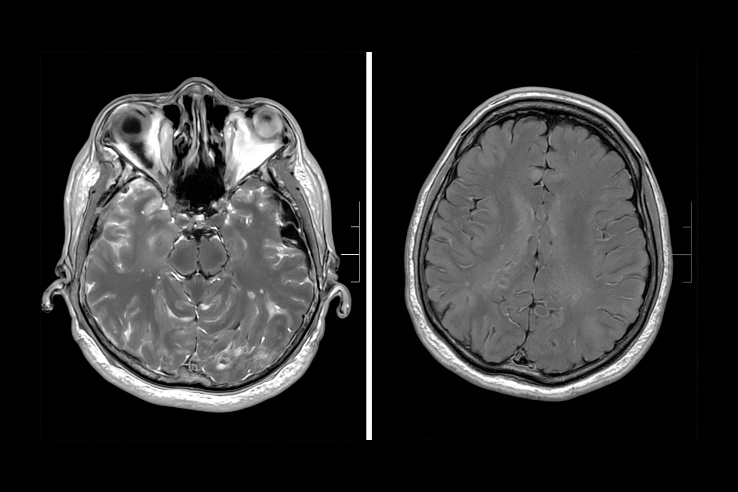 Idh-Mutant Glioma: Meaning, Prognosis, Vorasidenib, And Treatment Options 3 0 1 3 5 scaled