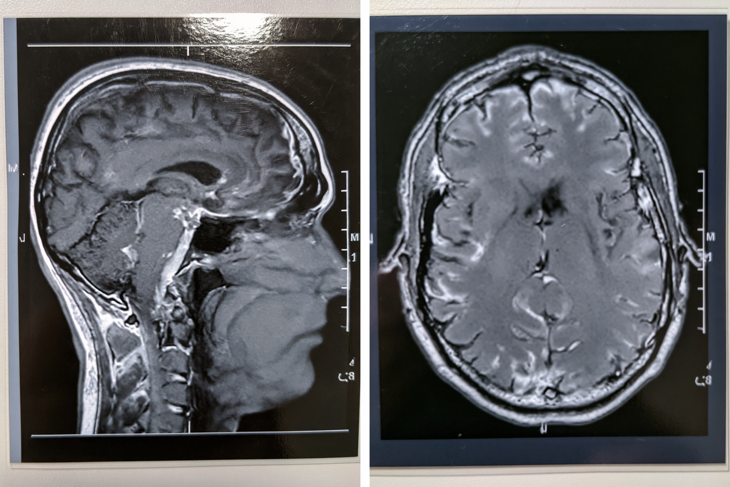 Glioma Vs Glioblastoma: Differences In Grade, Growth, Treatment, And Survival 7 0 1 7 2 scaled
