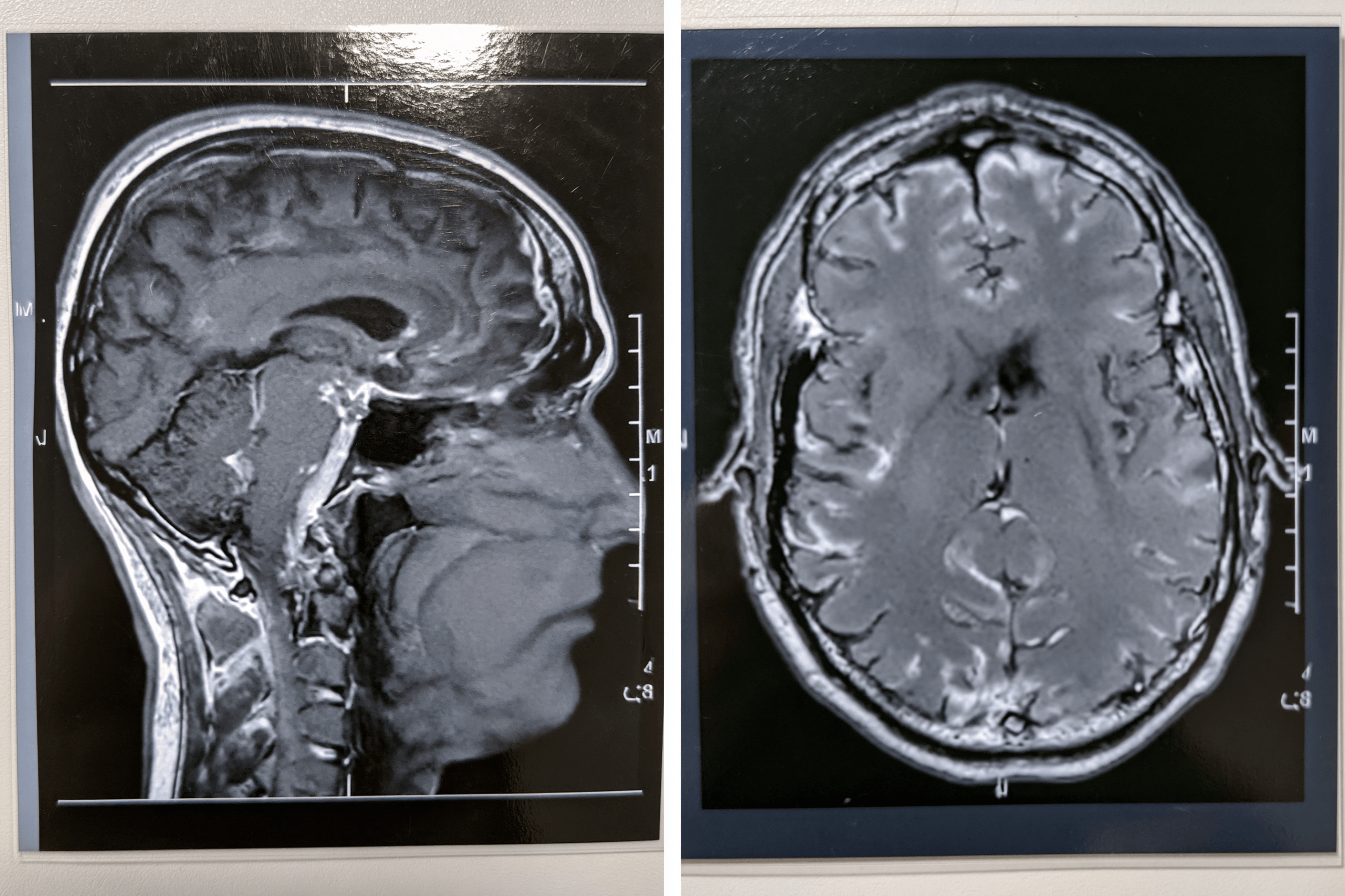Glioma Vs Glioblastoma: Differences In Grade, Growth, Treatment, And Survival 7 0 1 7 2 scaled