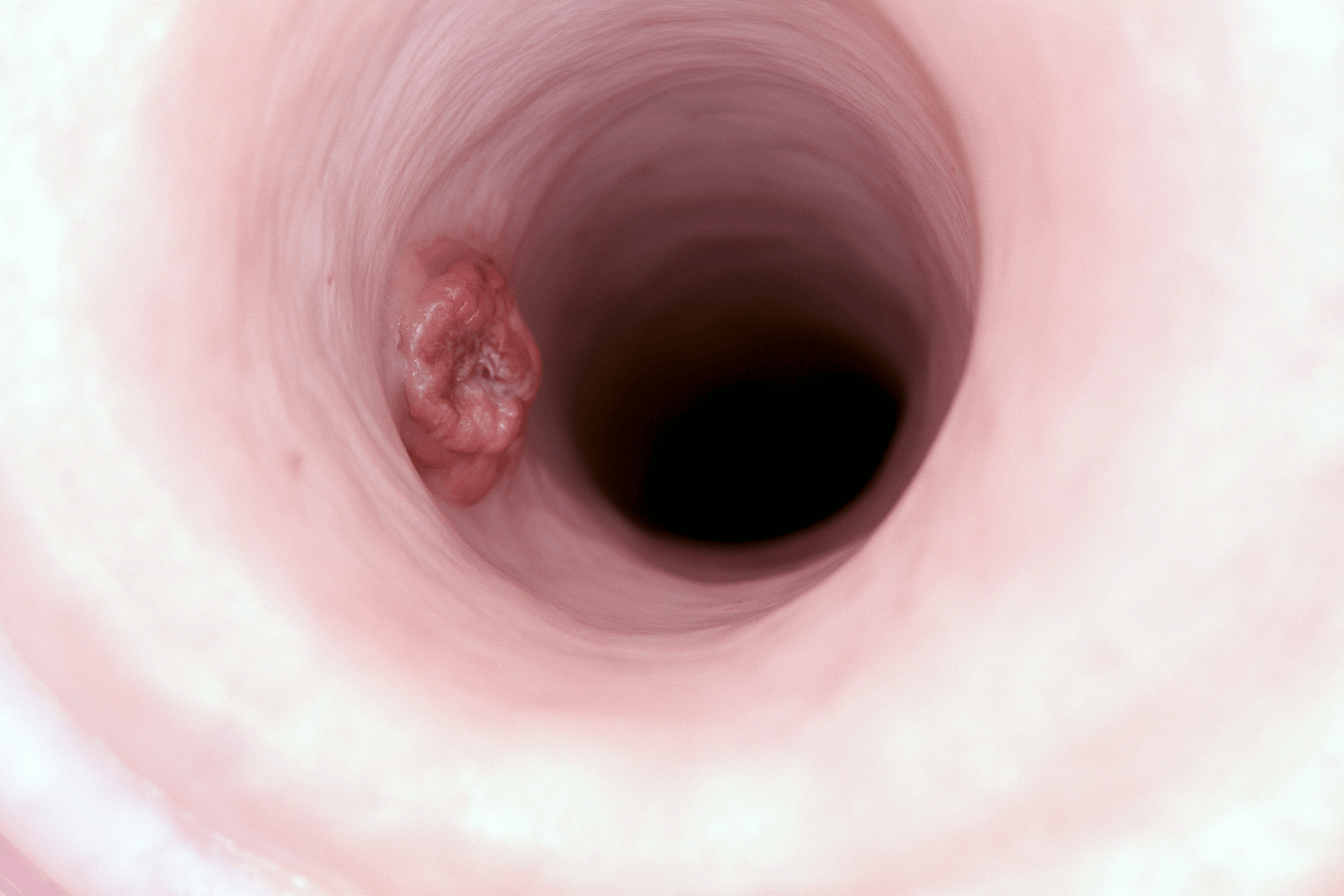 Metastatic Esophageal Cancer: Treatment, Survival And The Ayurveda Curative Model 3 0 3 50