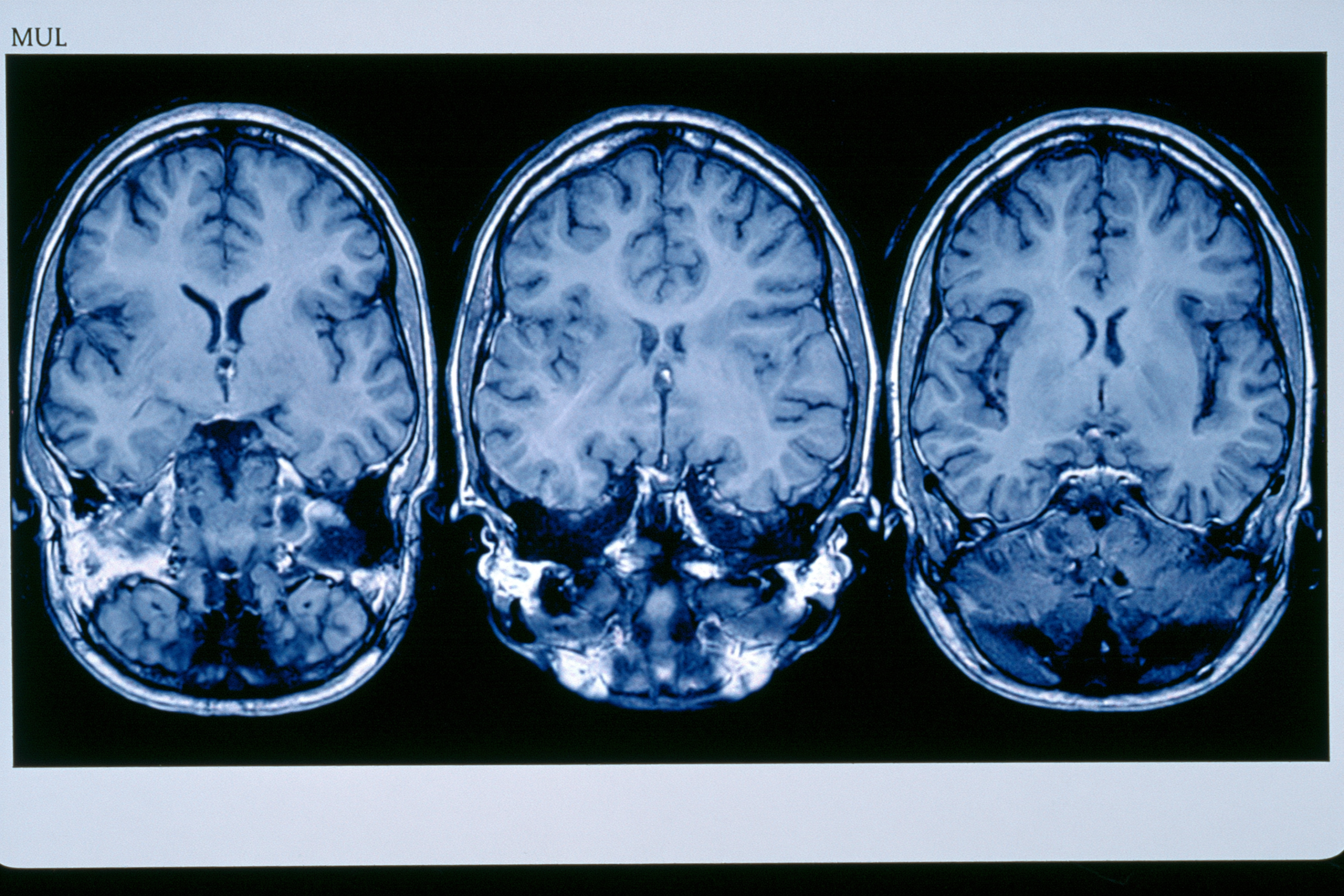 Glioma Vs Glioblastoma: Differences In Grade, Growth, Treatment, And Survival 4 0 3 6 6 scaled