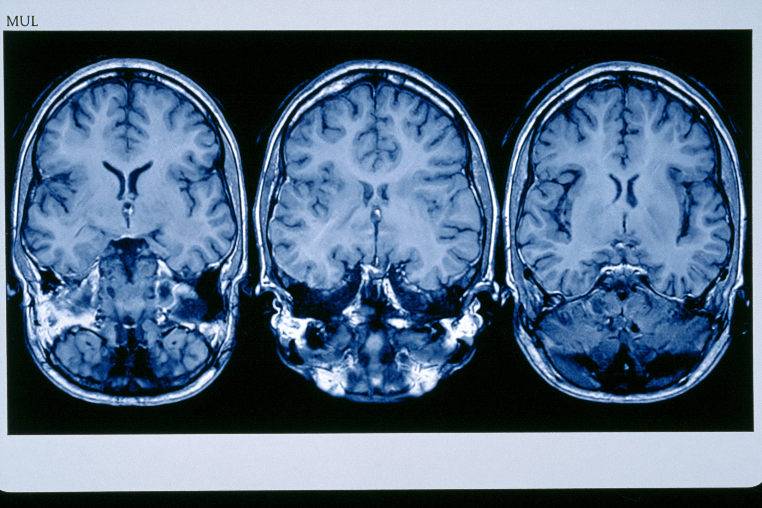 Glioma Vs Glioblastoma: Differences In Grade, Growth, Treatment, And Survival 4 0 3 6 6 scaled