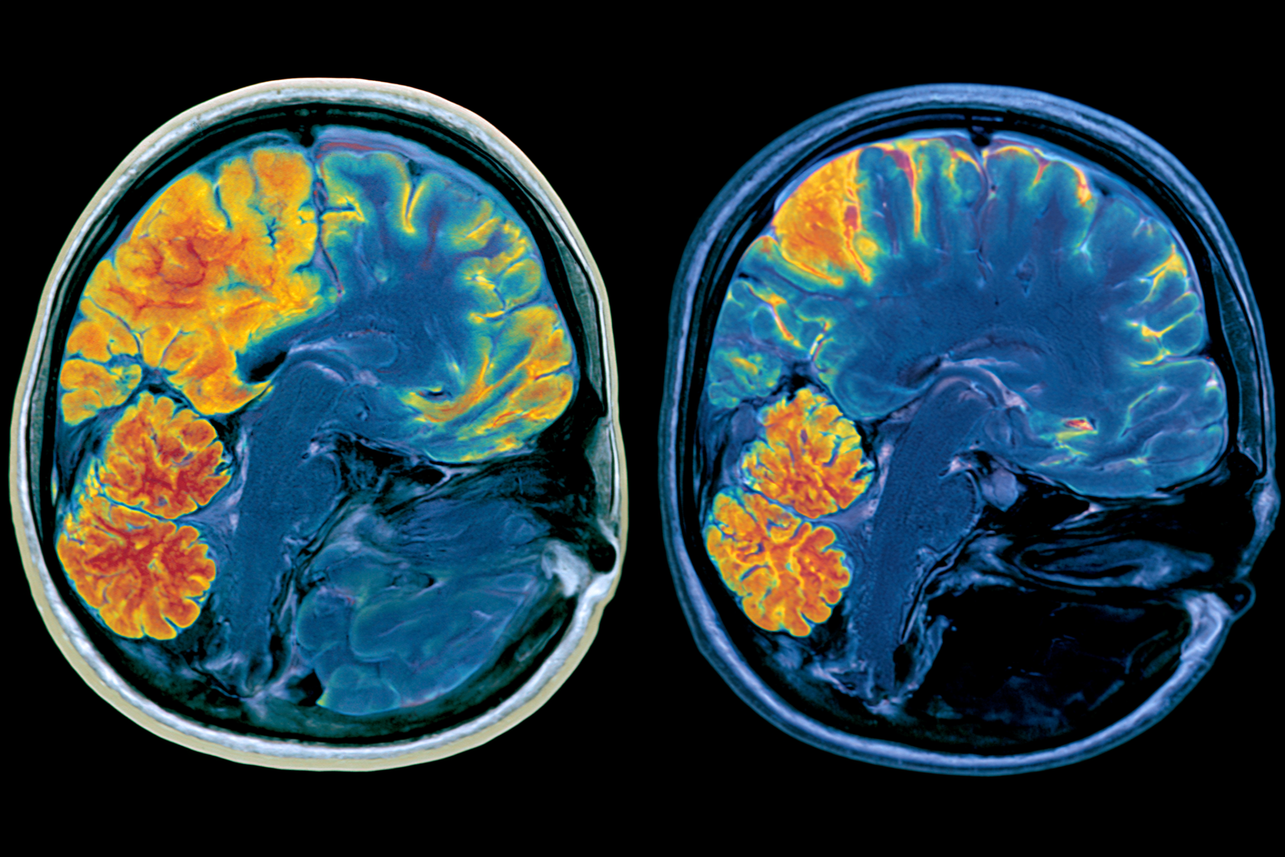 Glioma Vs Glioblastoma: Differences In Grade, Growth, Treatment, And Survival 5 0 3 7 4 scaled