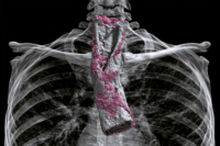 Three-dimensional CT reconstruction showing esophageal cancer tissue highlighted in pink within the thoracic esophagus against a transparent chest and rib cage anatomy.