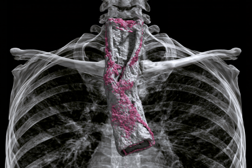 Three-dimensional CT reconstruction showing esophageal cancer tissue highlighted in pink within the thoracic esophagus against a transparent chest and rib cage anatomy.