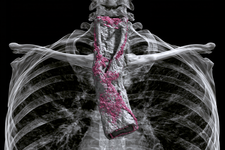 Three-dimensional CT reconstruction showing esophageal cancer tissue highlighted in pink within the thoracic esophagus against a transparent chest and rib cage anatomy.