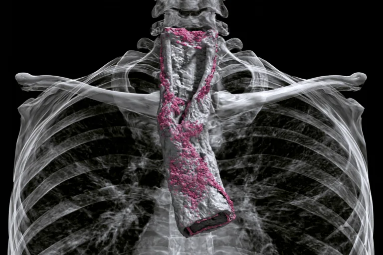 Three-dimensional ct reconstruction showing esophageal cancer tissue highlighted in pink within the thoracic esophagus against a transparent chest and rib cage anatomy.