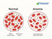 Ayurvedic treatment for anemia