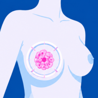 Breast Cancer - Natural care for breast health.