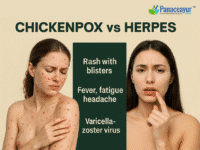 CHICKENPOX vs HERPES by panaceayur