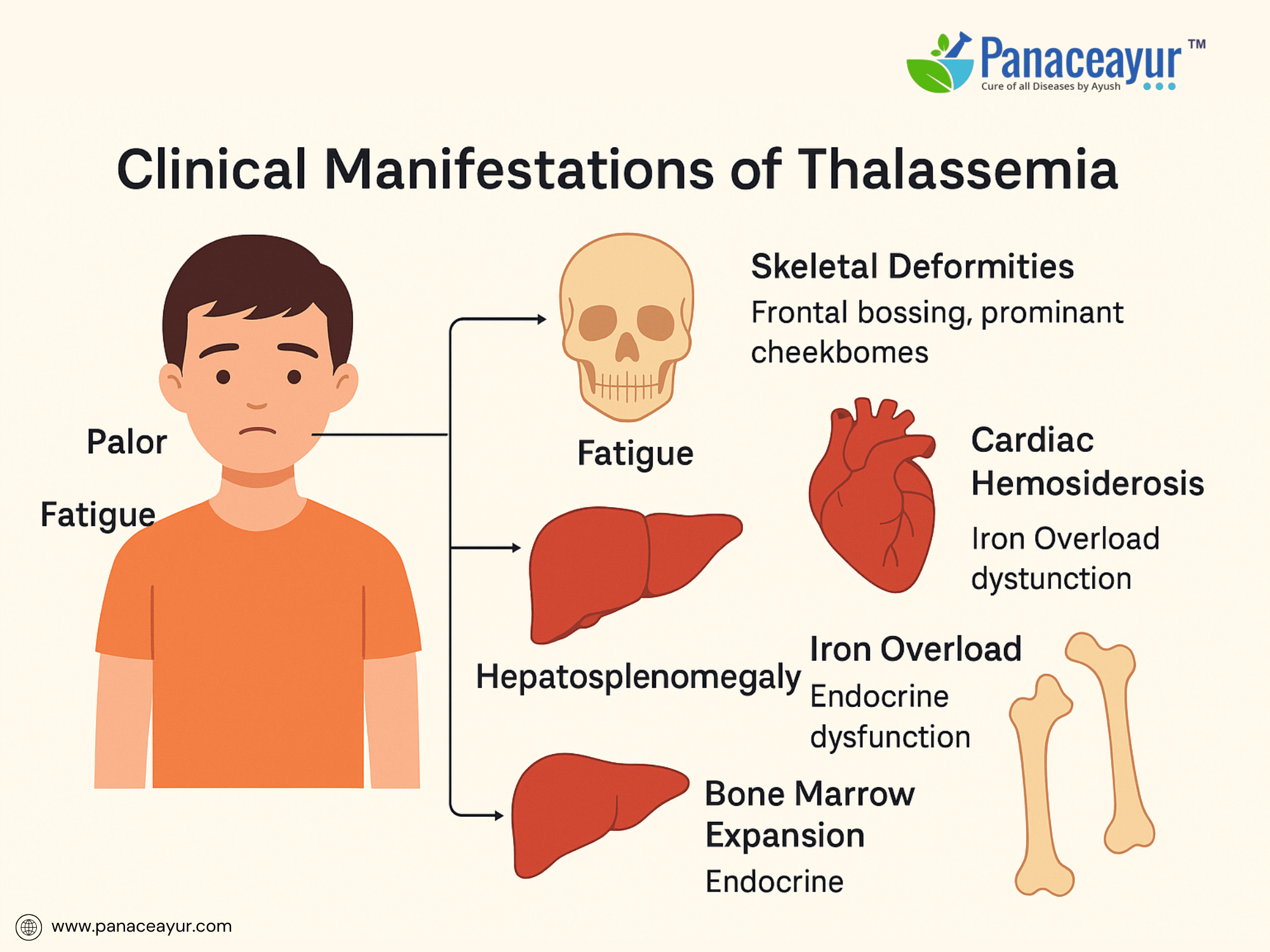 Clinical manifestations of thalassemia