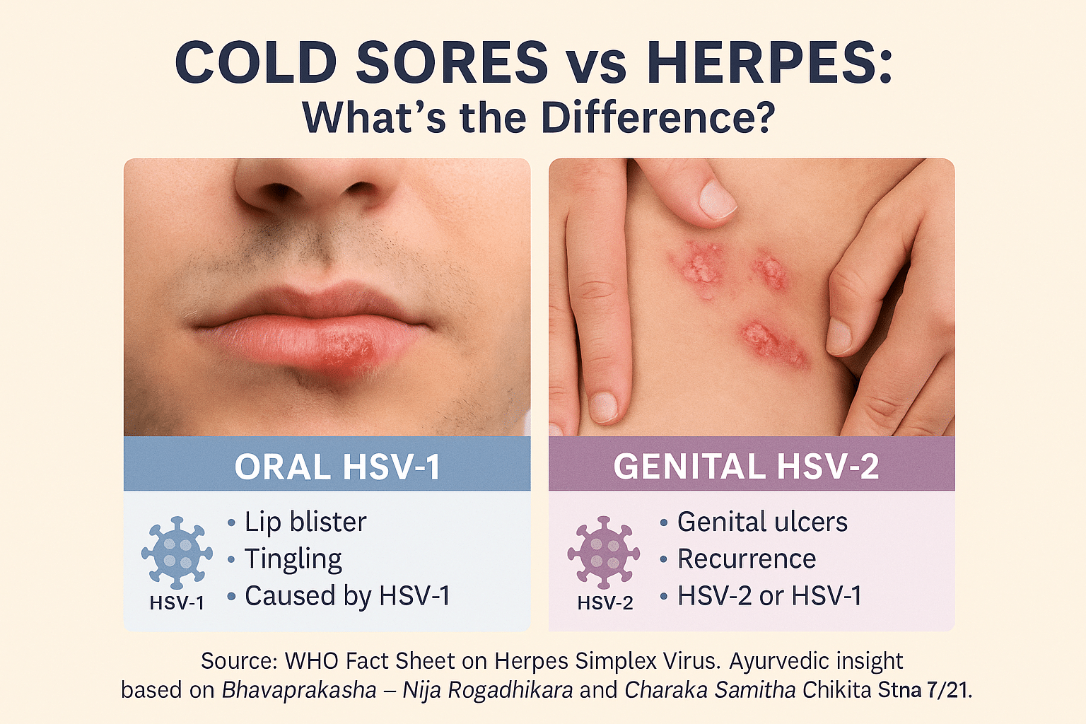 Cold sores vs herpes whats the difference