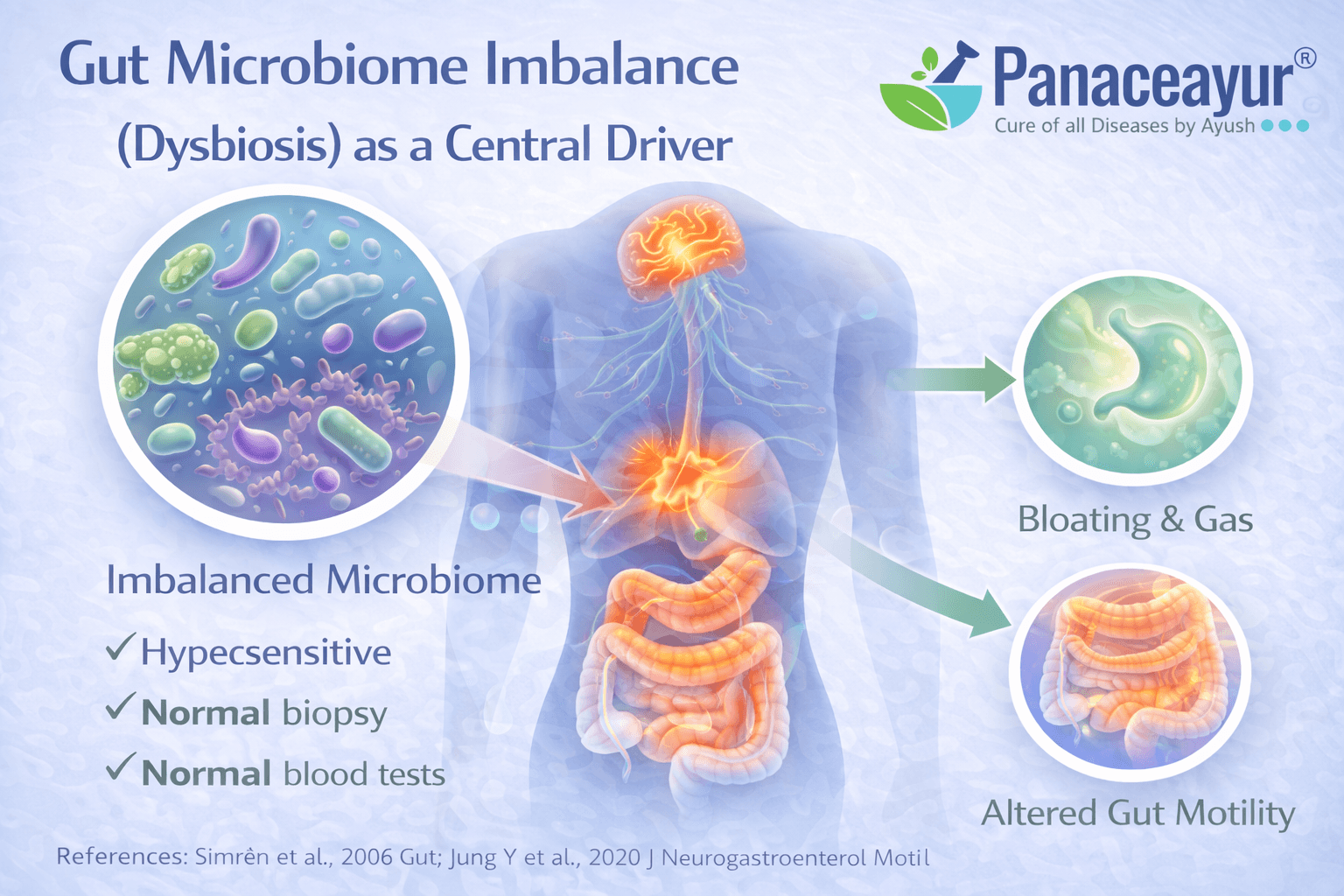Gut Microbiome Imbalance (Dysbiosis) As A Central Driver Clinical medical infographic illustrating gut microbiome imbalance in irritable bowel syndrome, showing reduced beneficial bacteria, altered microbial signaling, and their impact on gut function and symptoms.