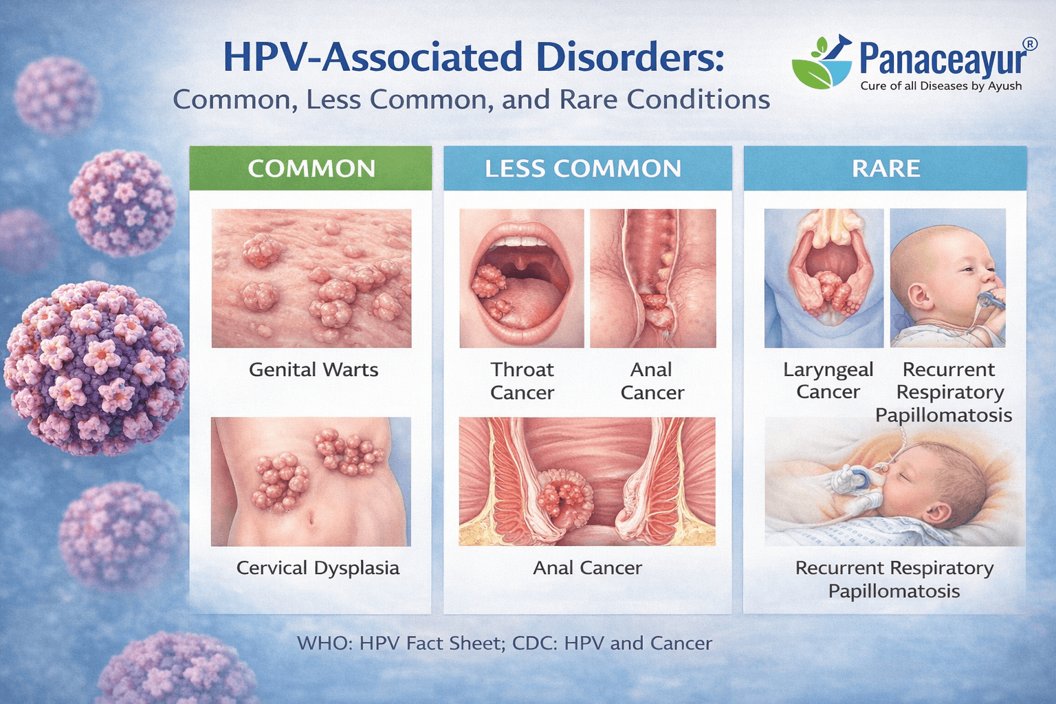 Hpv-associated disorders illustration showing common, less common, and rare conditions linked to human papillomavirus with clinical categorisation