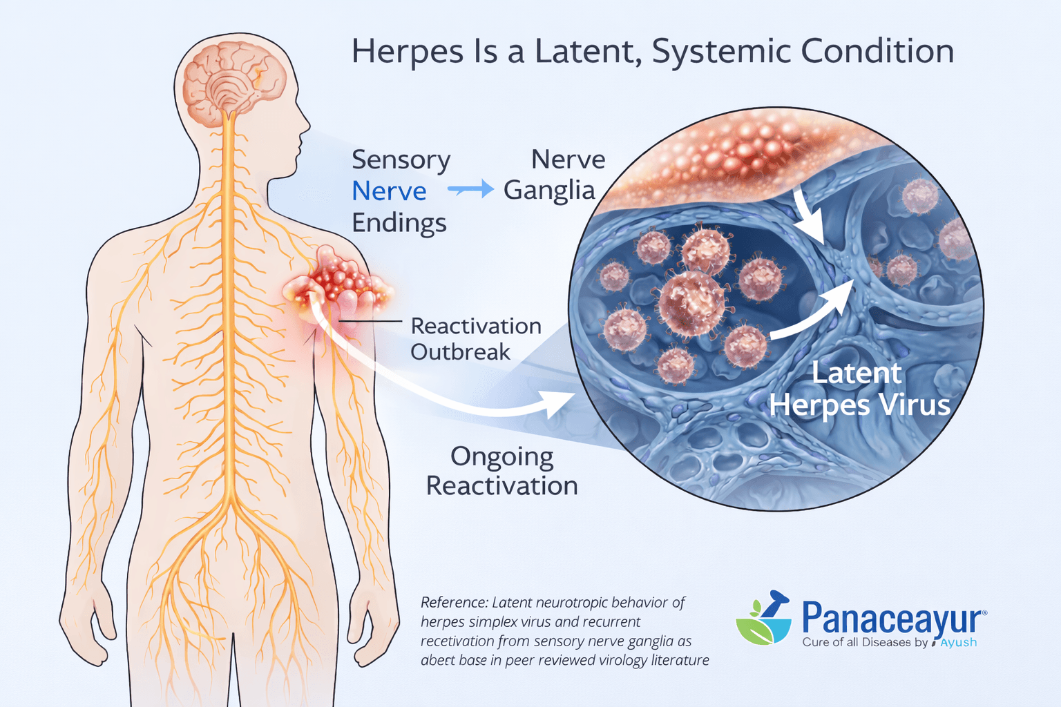 Herpes is a latent systemic viral condition