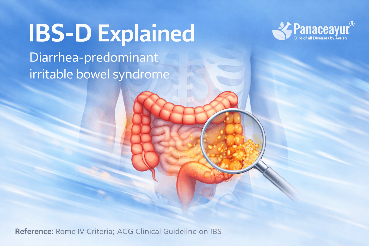 Ibs D Explained Diarrhea Predominant Irritable Bowel Syndrome Medical illustration explaining ibs d, a diarrhea predominant form of irritable bowel syndrome, highlighting urgency, frequent loose stools, and stool pattern based classification.