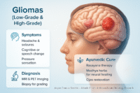 Photorealistic medical illustration of a gender-neutral human head showing low-grade and high-grade glioma tumors inside the brain, with concise panels describing symptoms, diagnostic methods, and Ayurvedic cure including Rasayana therapy and Ojas restoration.