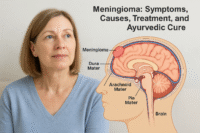 Real female model with transparent side-view brain illustration highlighting meningioma tumor on the meninges, labeled dura mater, arachnoid mater, and pia mater, in Healthline-style educational design.
