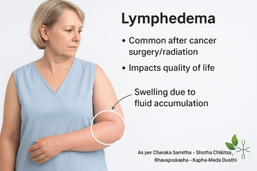 Photorealistic medical illustration of lymphedema in a breast cancer survivor showing swelling in the left arm, highlighting symptoms, diagnosis, and Ayurvedic care options.