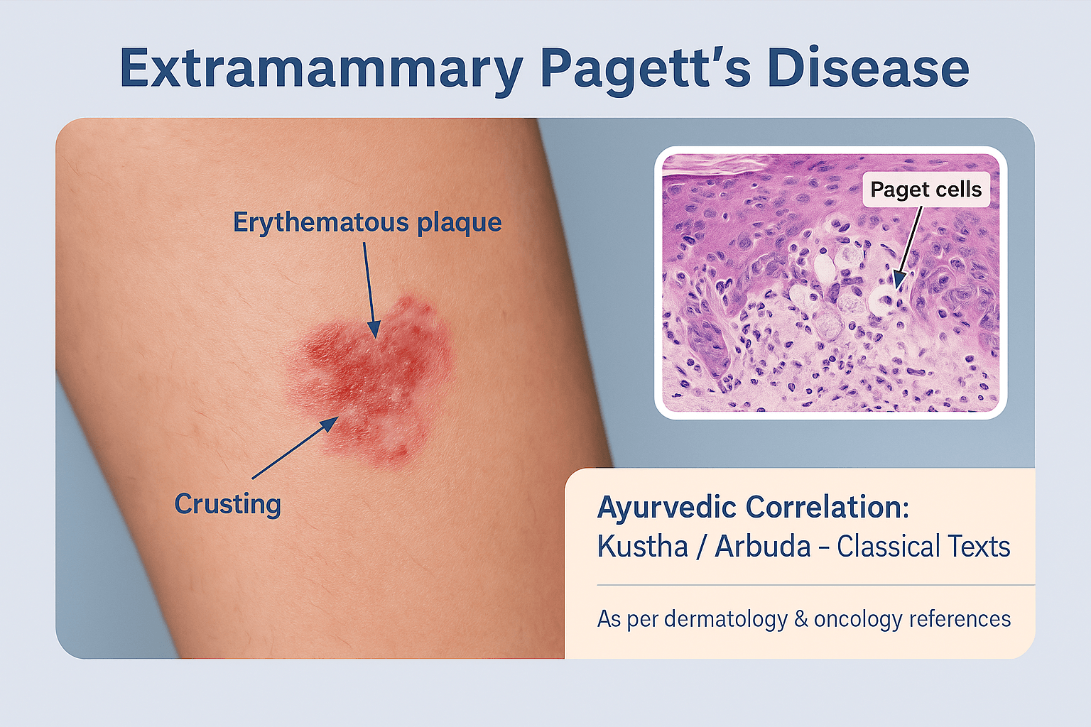 Photorealistic medical infographic of Extramammary Paget’s Disease showing a red, scaly plaque lesion with crusting, histology inset of Paget cells, and Ayurvedic correlation.