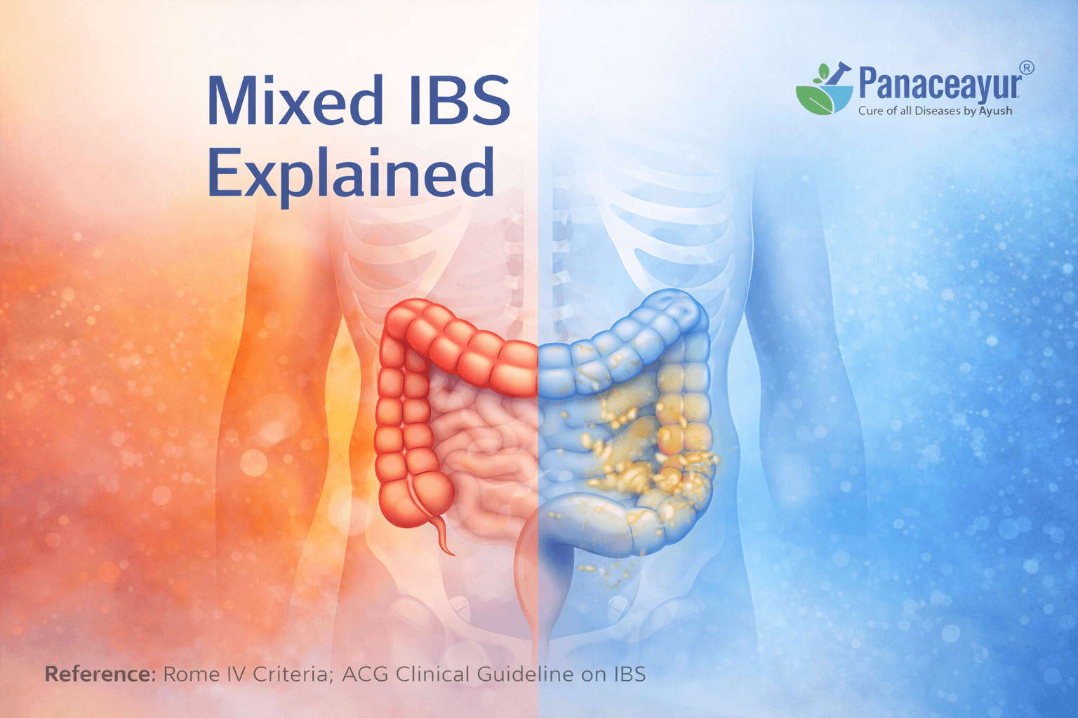 Ibs M Explained Mixed Type Irritable Bowel Syndrome Medical illustration explaining ibs m, the mixed type of irritable bowel syndrome, characterized by alternating constipation and diarrhea with fluctuating stool patterns.