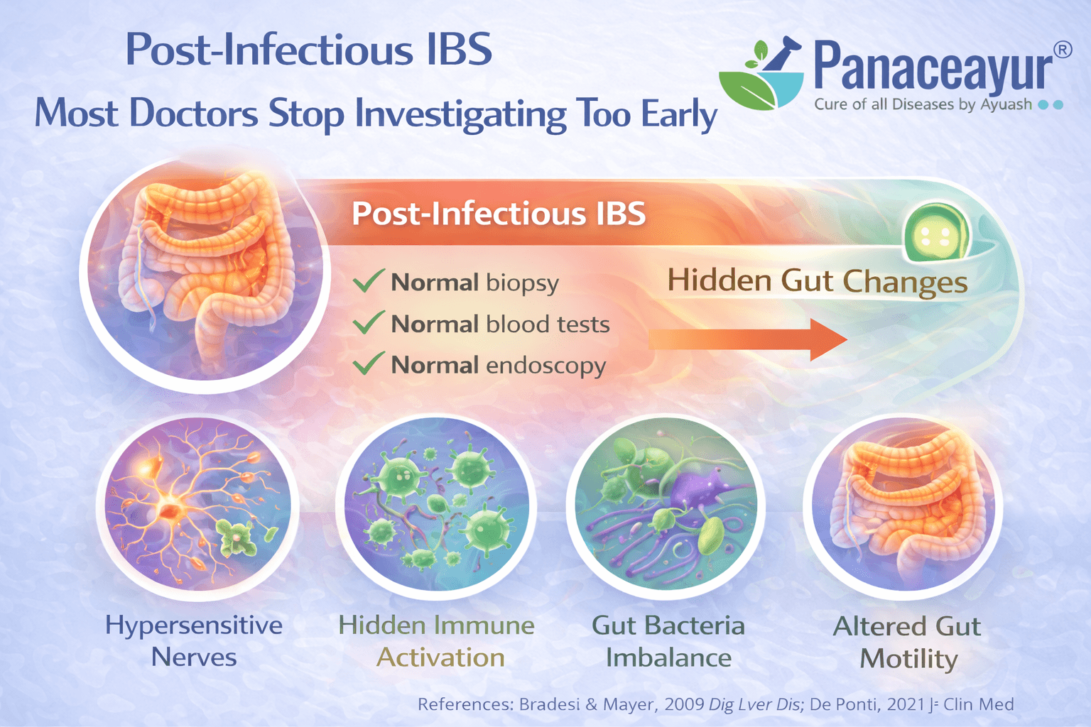 Post-Infectious Ibs Most Doctors Stop Investigating Too Early Clinical medical infographic illustrating post-infectious irritable bowel syndrome, showing how a prior stomach infection leads to long-term gut nerve, immune, and microbiome changes despite infection resolution.