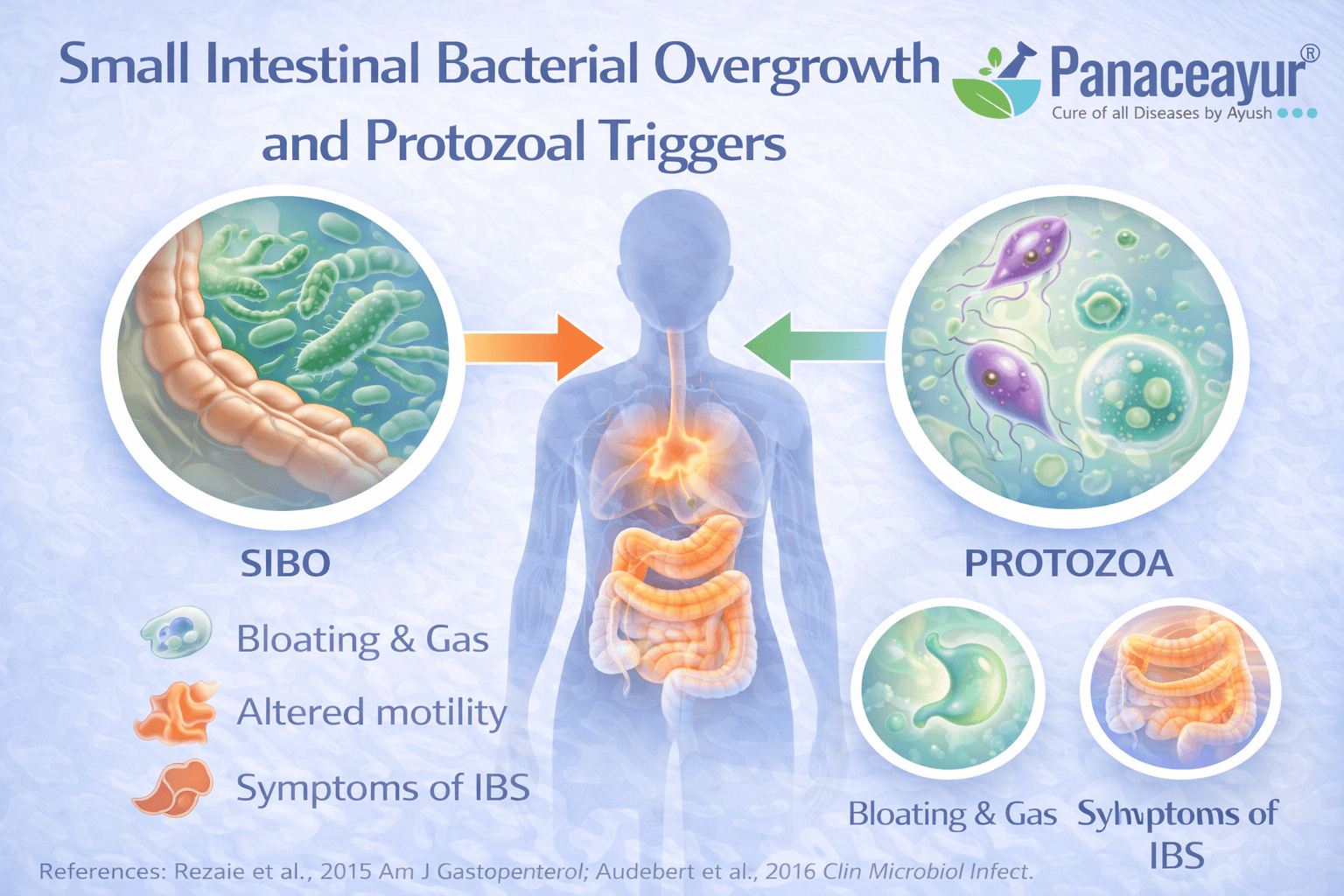 Small Intestinal Bacterial Overgrowth And Protozoal Triggers Diagnostic medical infographic illustrating small intestinal bacterial overgrowth and protozoal triggers in ibs, highlighting abnormal bacterial fermentation in the small intestine and its impact on bloating, gas, and bowel symptoms.