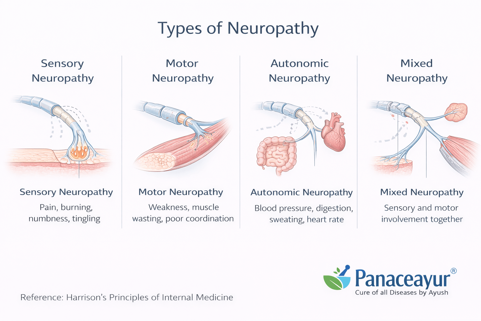 Types of neuropathy