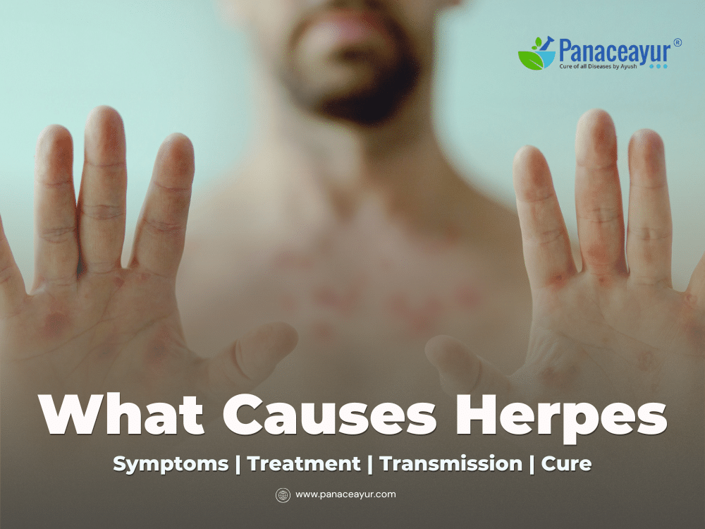 What Causes Herpes 8 What causes herpes by dr