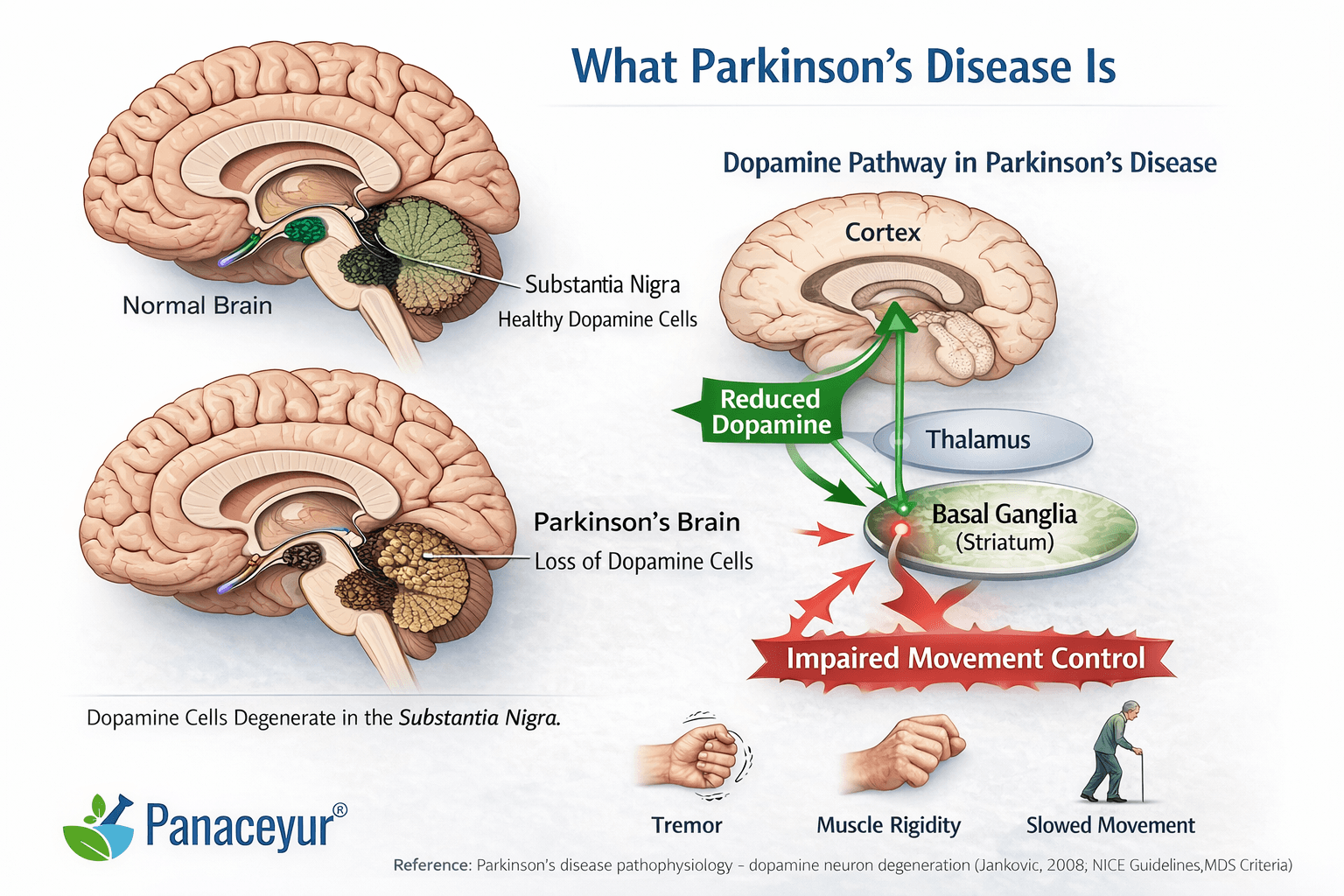 Medical illustration showing dopamine loss in the substantia nigra and basal ganglia pathway in parkinson’s disease.