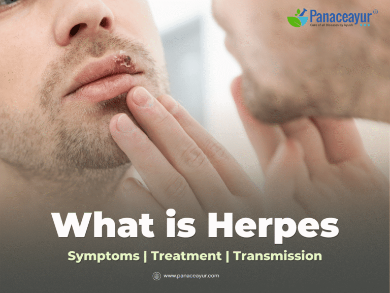 What is Herpes