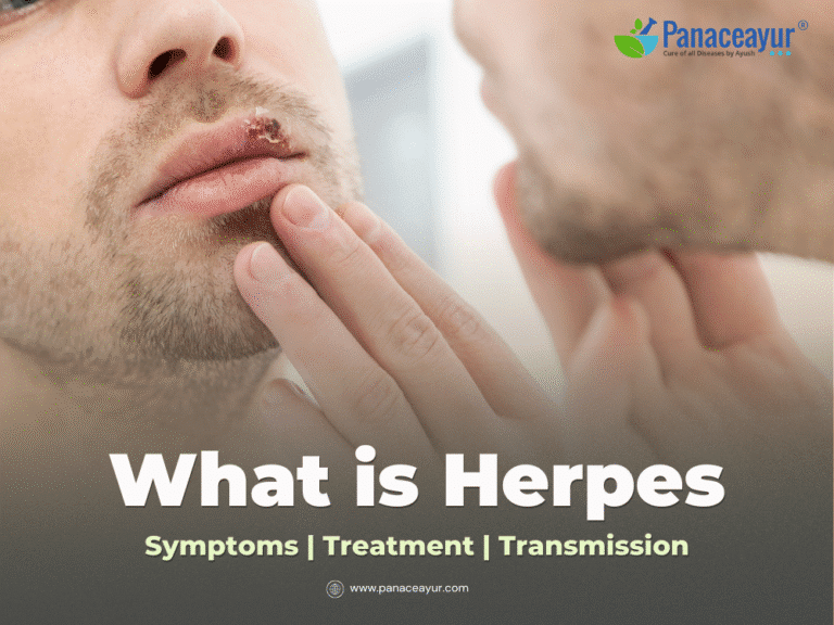 What is Herpes