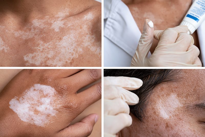 Comparison of fungal white patches and vitiligo showing why antifungal cream only treats confirmed fungal skin infection.