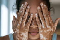Woman with visible vitiligo patches on both hands covering her face