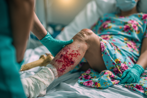 Teenage bone sarcoma patient in orthopedic oncology consultation with MRI scans showing osteosarcoma and Ewing sarcoma, alongside integrative Ayurvedic and modern cancer care discussion.