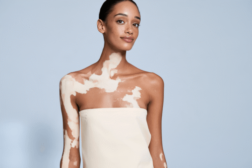 Woman with vitiligo patches across her neck, upper chest, shoulder and arm.