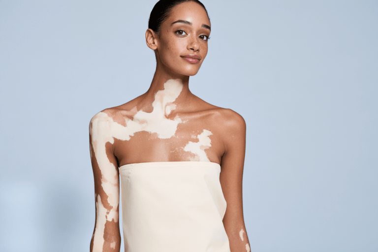 Woman with vitiligo patches across her neck, upper chest, shoulder and arm.