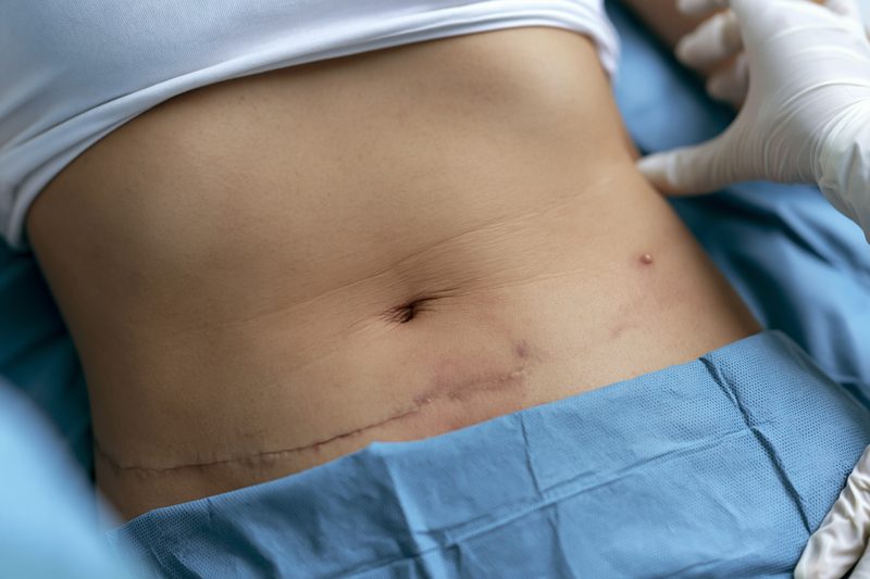 Desmoid Tumor Symptoms: Recognize Lumps, Pain And Abdominal Warning Signs 7 Desmoid tumor risk factors abdominal wall woman