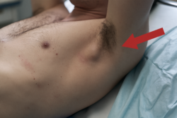 Desmoid tumor symptoms showing a visible firm lump near the axilla and lateral chest wall in a male patient.