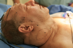 Clinical illustration of a man with a large cervical desmoid tumor undergoing specialist treatment assessment