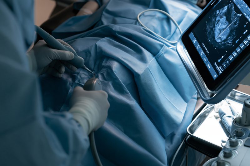 Desmoid Tumor Symptoms: Recognize Lumps, Pain And Abdominal Warning Signs 9 Desmoid tumor ultrasound guided core biopsy
