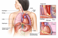 Esophageal cancer dysphagia anatomy showing tumor near the esophagus and lymph node involvement